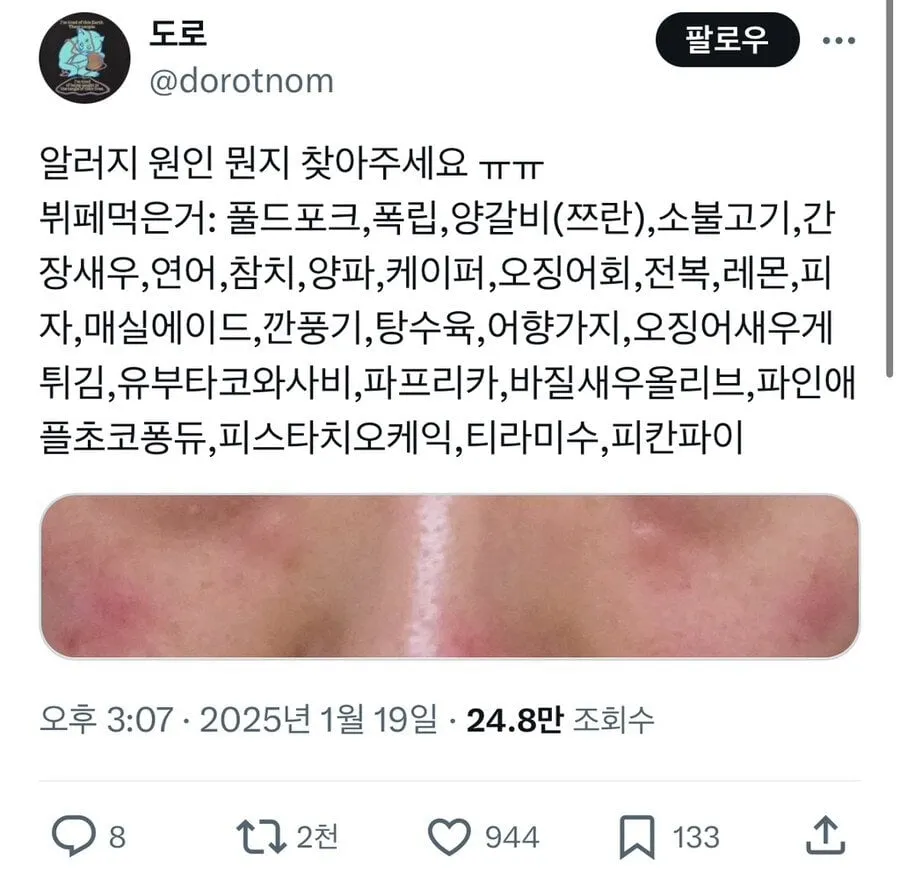 뷔페 가고 왜 알러지가 올라온지 모르겠다는 사람