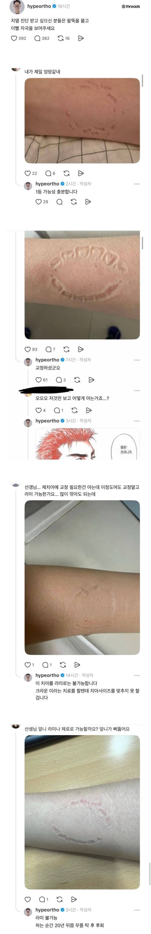 치열 진단 받고 싶으신 분들은 팔뚝을 물고 이빨 자국을 보여주세요 