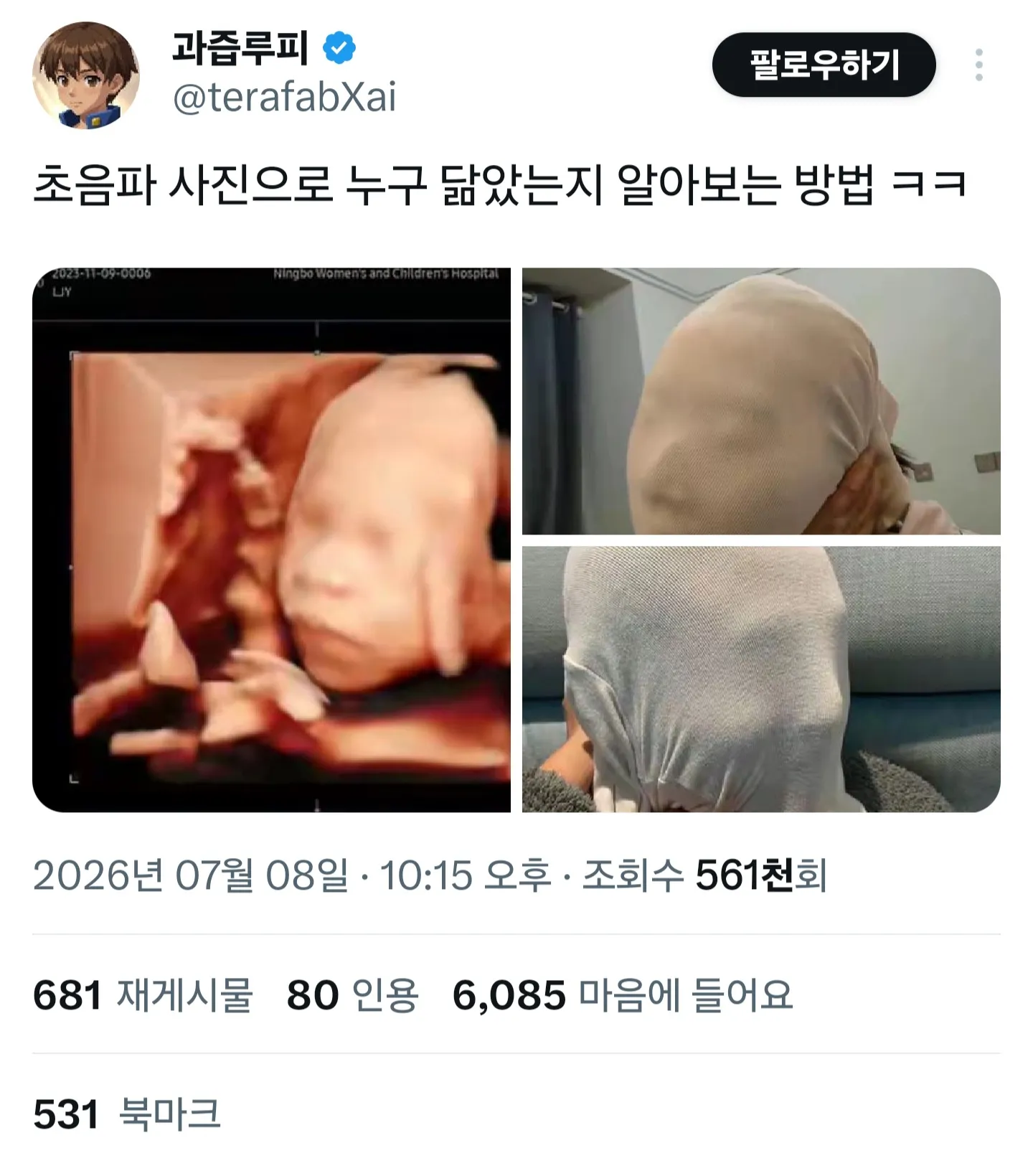 초음파 사진 누구 닮았는지 알아보는 방법
