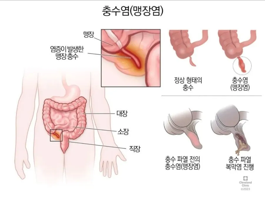 인류의 수명을 거의 두배로 늘려준 수술