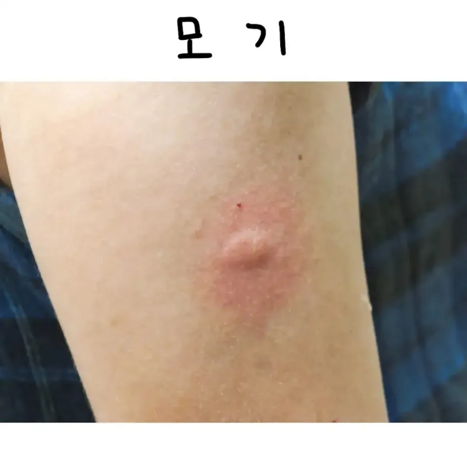 혐오) 종류 별로 물렸을 때 자국
