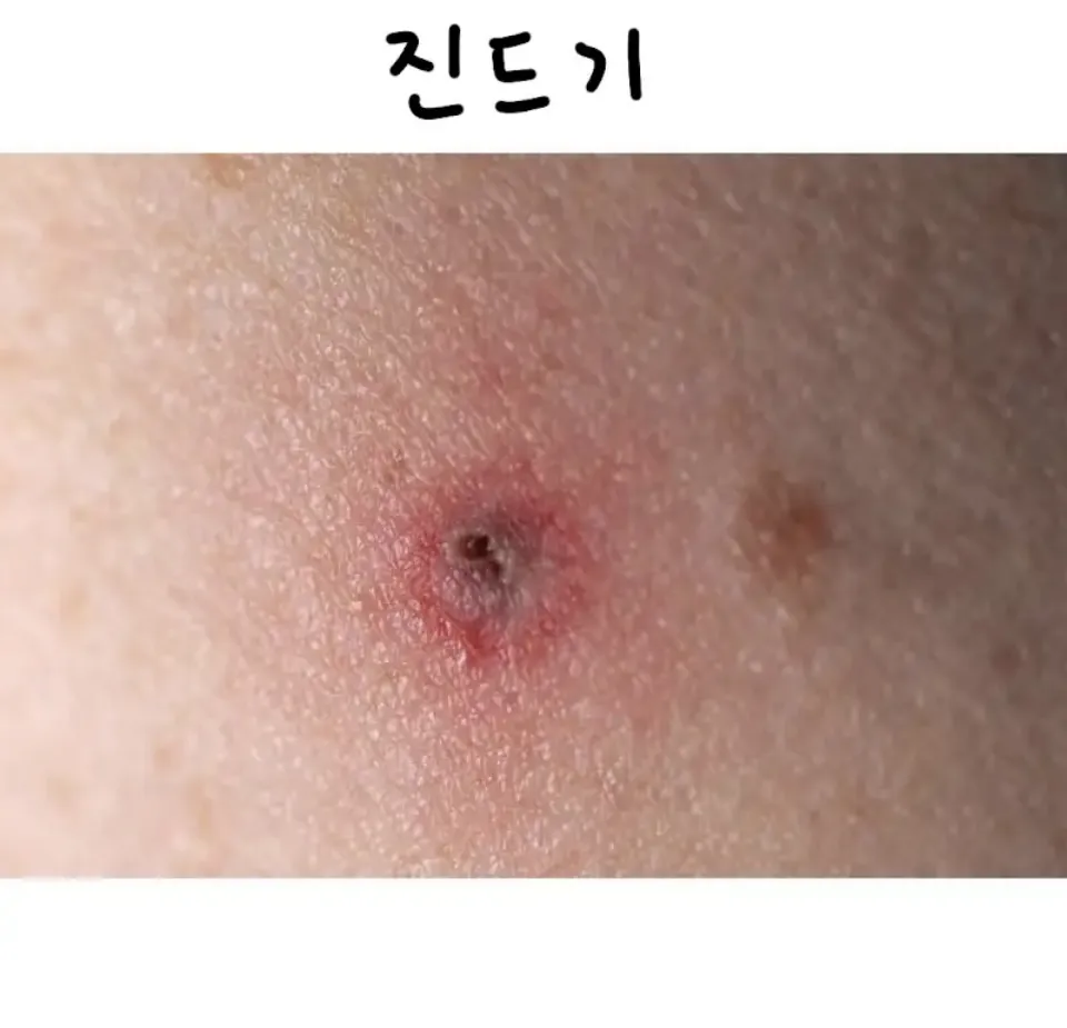 혐오) 종류 별로 물렸을 때 자국