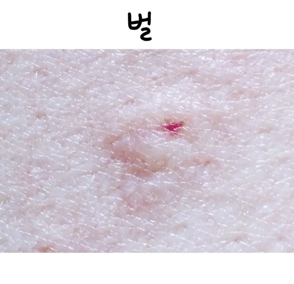 혐오) 종류 별로 물렸을 때 자국