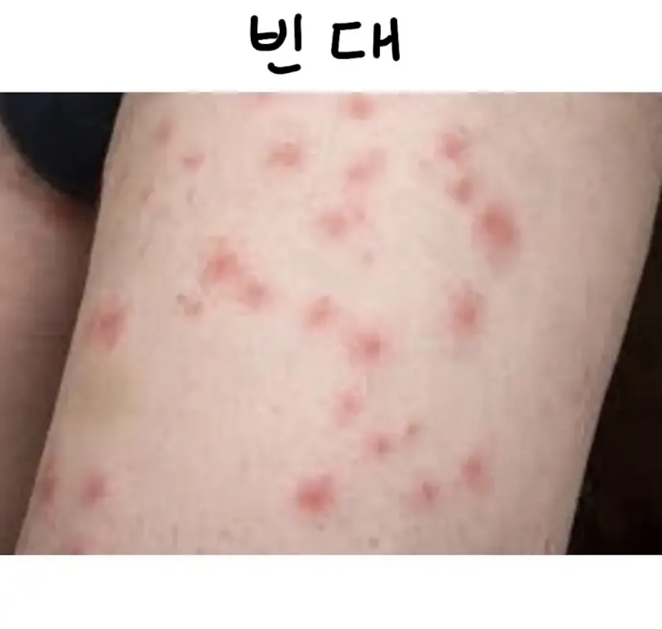 혐오) 종류 별로 물렸을 때 자국