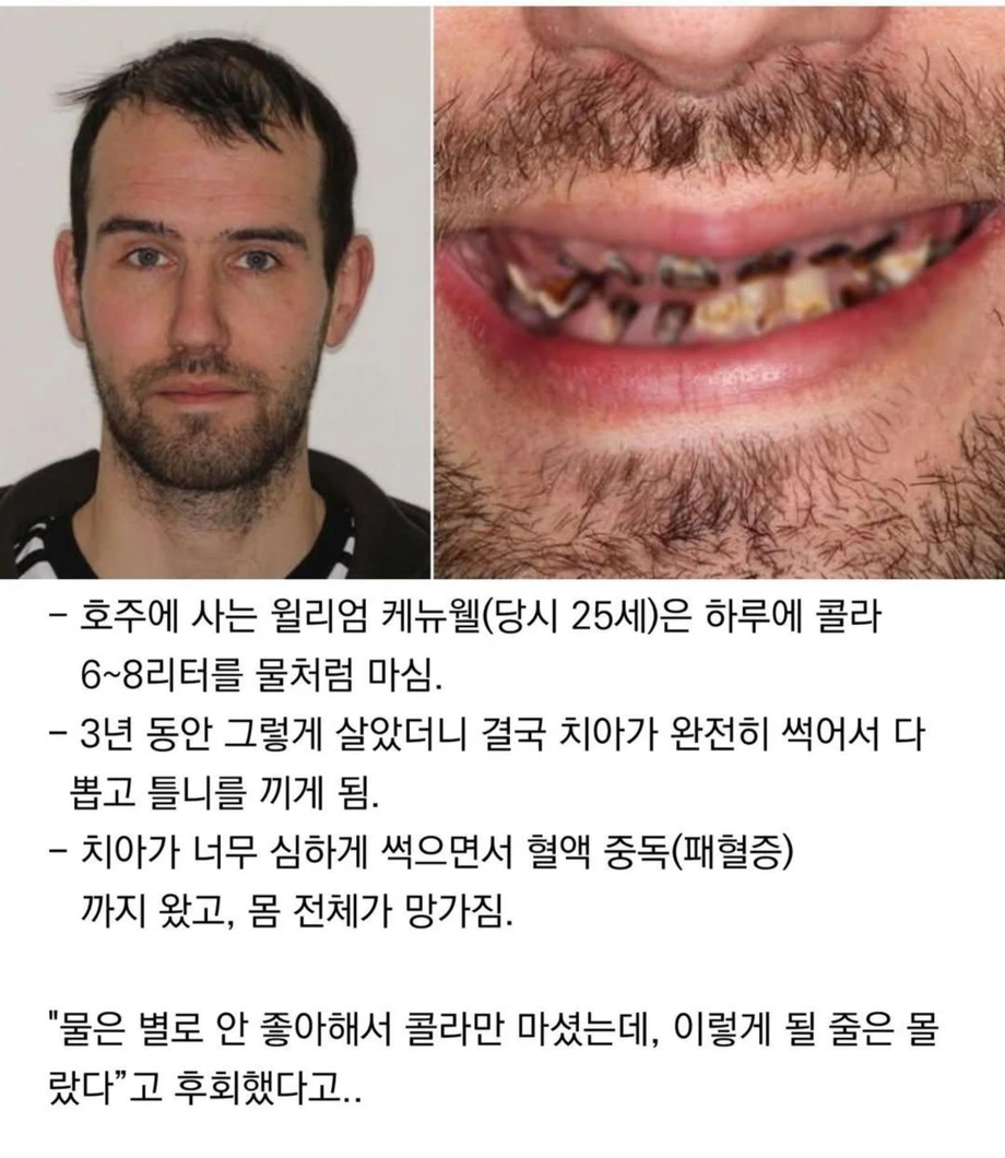 3년간 콜라먹은 남자 최후