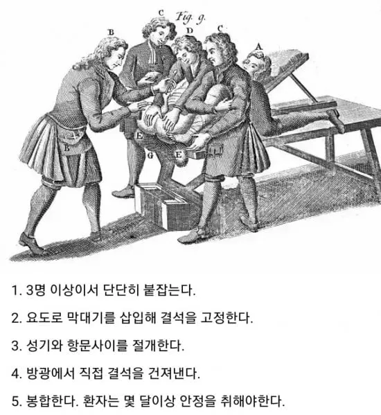 마틴 루터 요로결석 썰